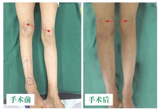 女孩墜梯右腿縮短5cm，幸得醫(yī)生及時(shí)診治恢復(fù)正常腿型