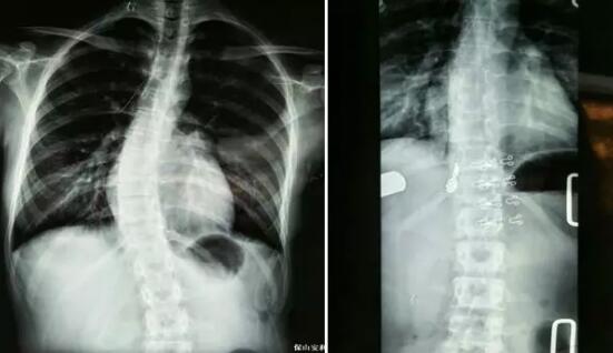 好好的脊柱怎么說彎就彎了？你竟然都沒發(fā)現(xiàn)……