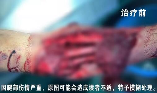 感謝安利醫(yī)院挽救了我的腿，沒有讓我落下殘疾……”