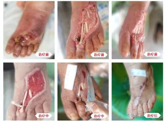 糖尿病并發(fā)癥有多可怕，及時治療糖尿病足避免截肢！