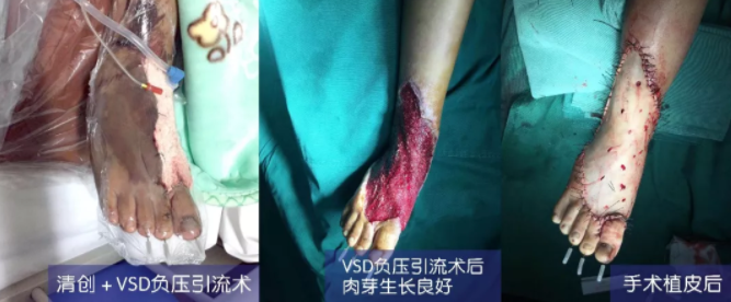 車禍猛如虎，救治如“華佗” ，手術(shù)＋康復(fù)，8歲小女孩車禍后日漸康復(fù)行走