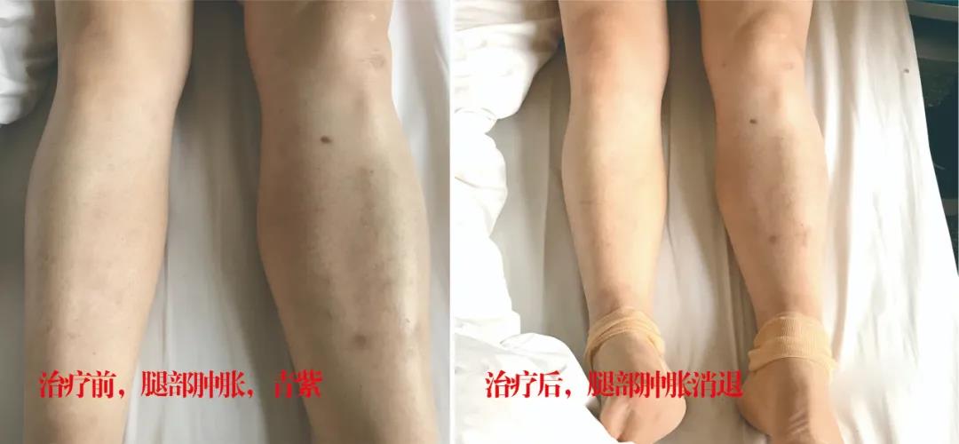 下肢靜脈血栓多年頑疾反復腫痛——疾病不容等待，早治療，早健康！