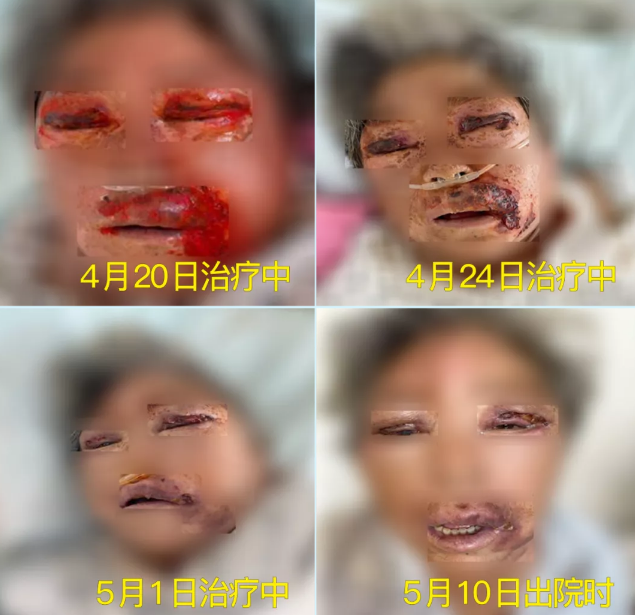 膿毒血癥（急性頜面部蜂窩組織炎）多學(xué)科聯(lián)合會(huì)診，幫助患者成功治愈！