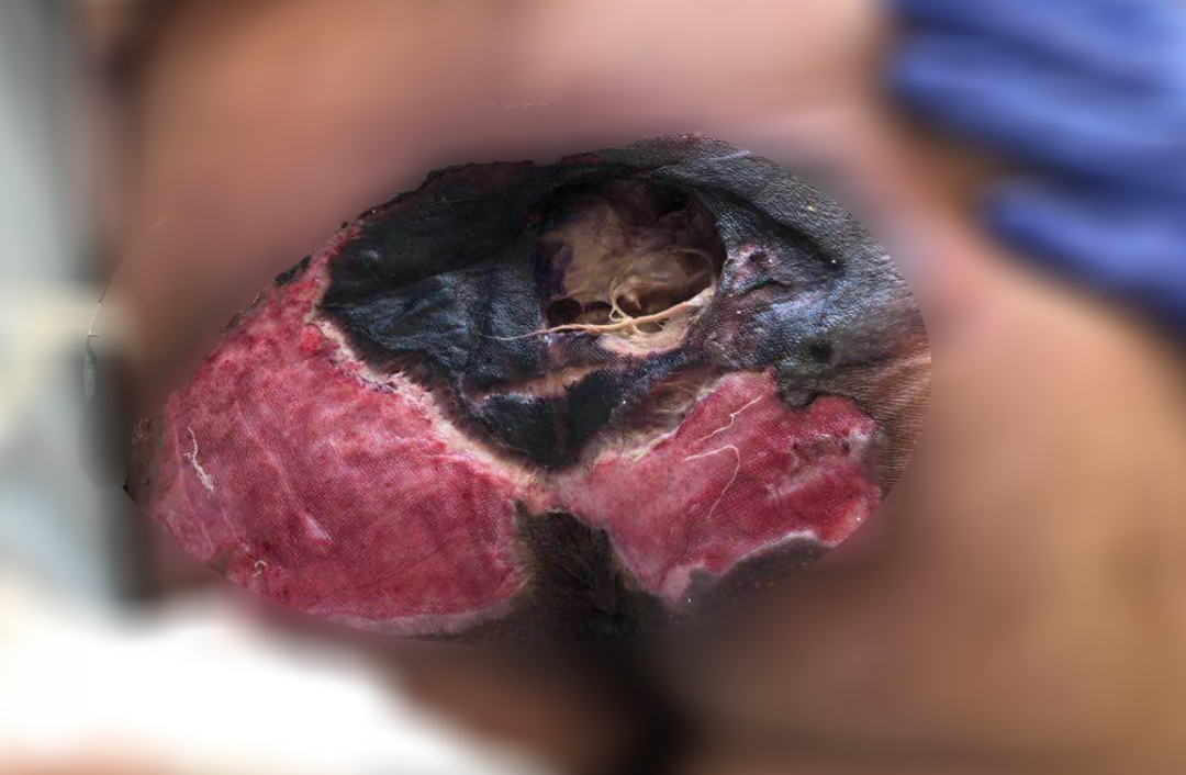 癱瘓3年的女患者臀部居然變成這樣?！