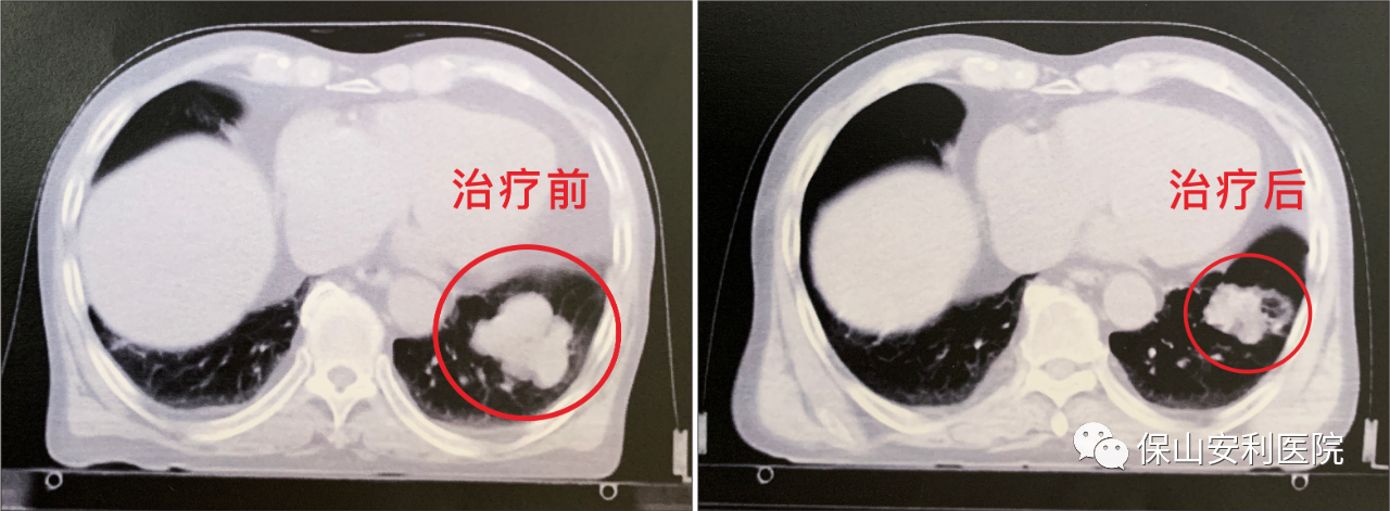 不做手術(shù)，早期肺癌也能根治！