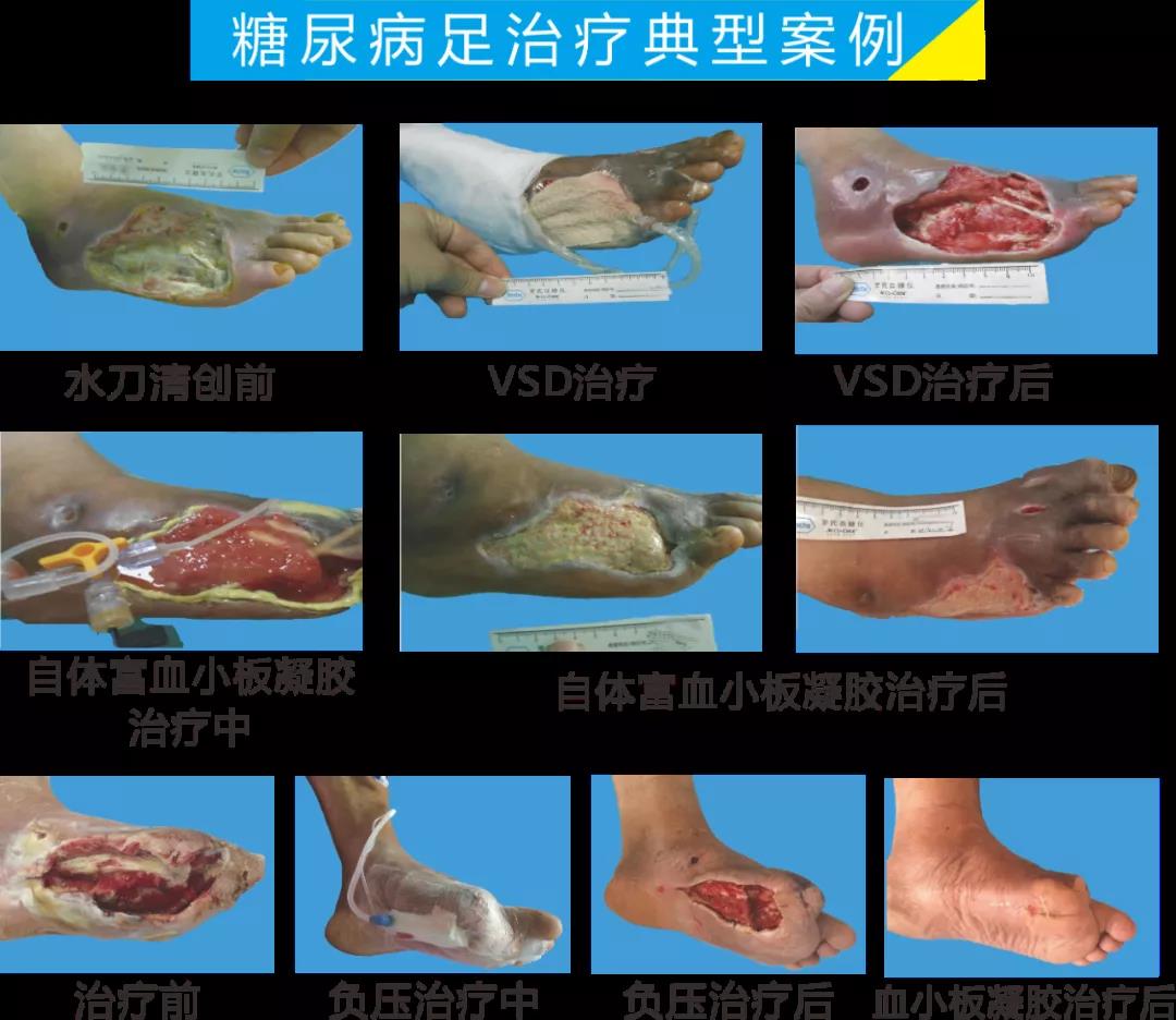 截肢、失明，甚至……，我們要做的是將糖尿病并發(fā)癥遏制在搖籃里！