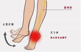 【保山安利醫(yī)院—健康科普】什么是足下垂！你了解嗎？